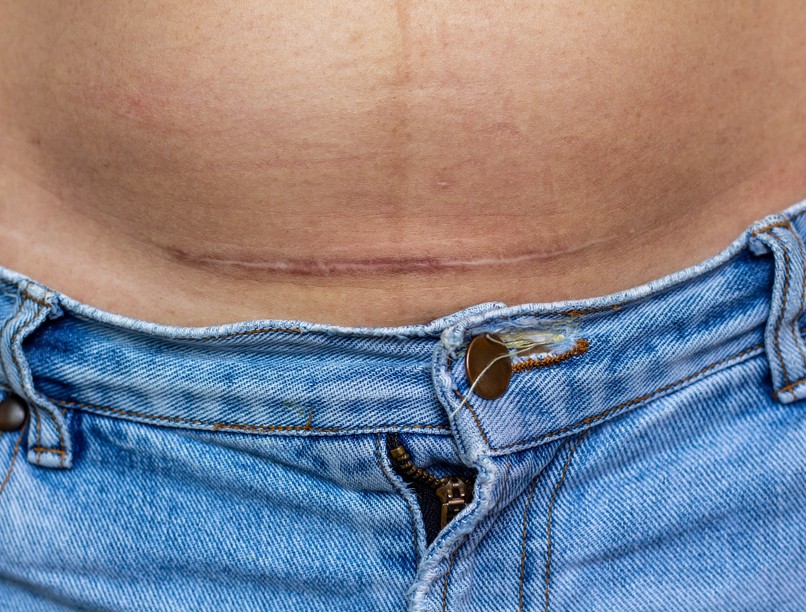 hírek császármetszés után hegtudatos