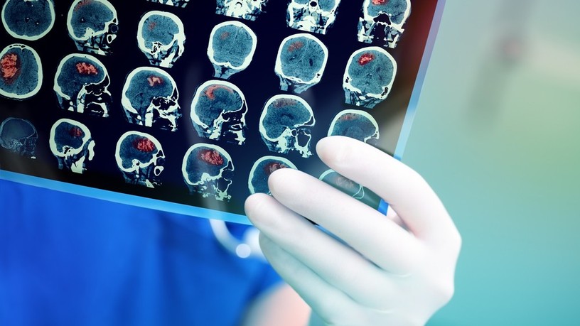 stroke, kockázata, Ischaemiás stroke, ülőmunka, tünetei
