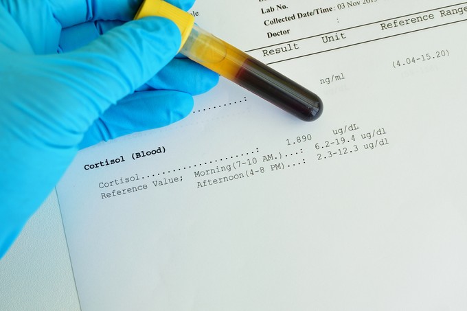 Mit jelent a kortizol érték a laborleleten? című cikk nyitóképe