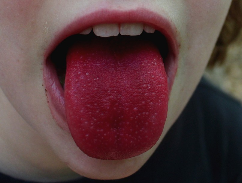 epernyelv, kiütések, torokfájás skarlát tünetei