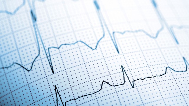 Gyorsabban olvassa az EKG-t, mint az orvosok? Egy új AI-eszköz másodpercek alatt kiszúrja a két legveszélyesebb szívbetegséget az EKG-ból