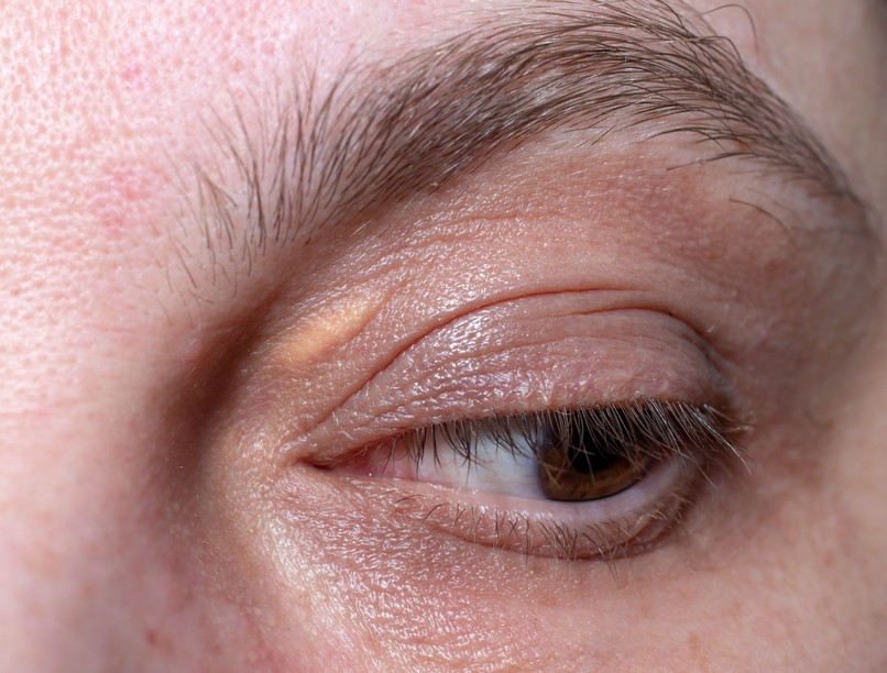 szemhéj, sárgás csomó infarktus