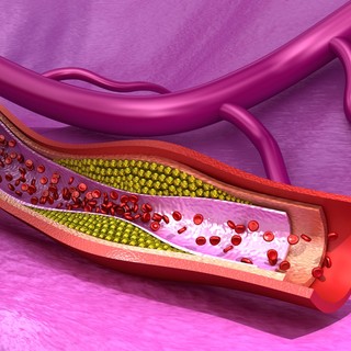 Stroke és artériás trombózis - 10 másodperc alatt kialakulhat című cikk nyitóképe