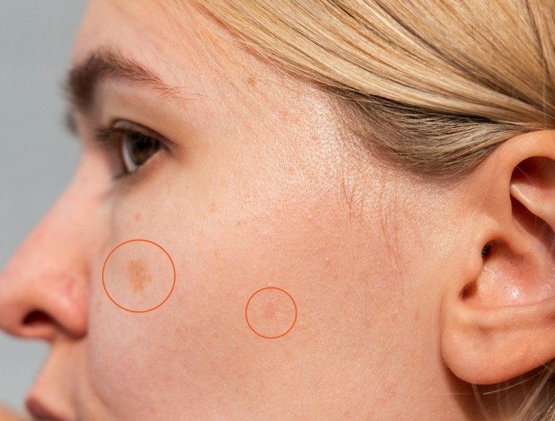 öregségi foltokmik oka