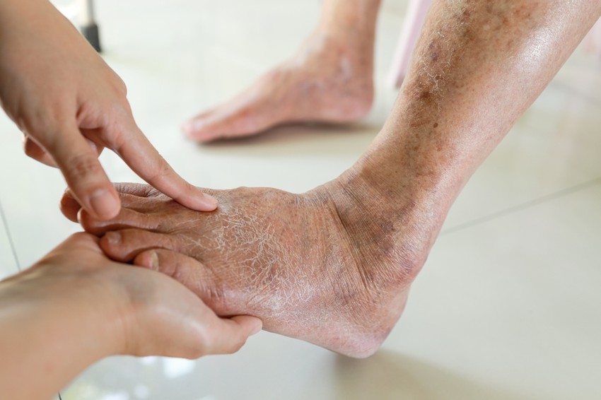 A szívelégtelenség okozta tünetek általában lassan alakulnak ki, és az évek alatt súlyosbodnak.