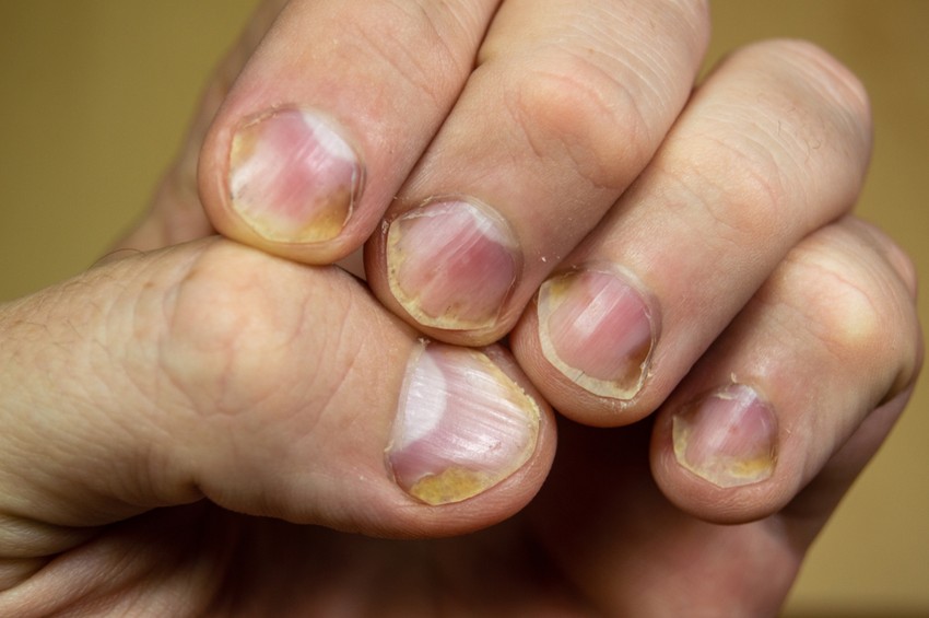 Az Beau-vonalak olyan apró mélyedések, melyek a köröm növekedési zavarát jelzik. Jelezhet krónikus betegséget, de a tartósan fennálló kalciumhiány is kiválthatja.