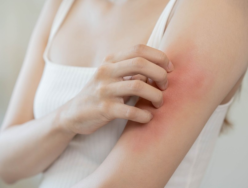 Parlagfű allergia jele, szem, bőr, torokviszketés