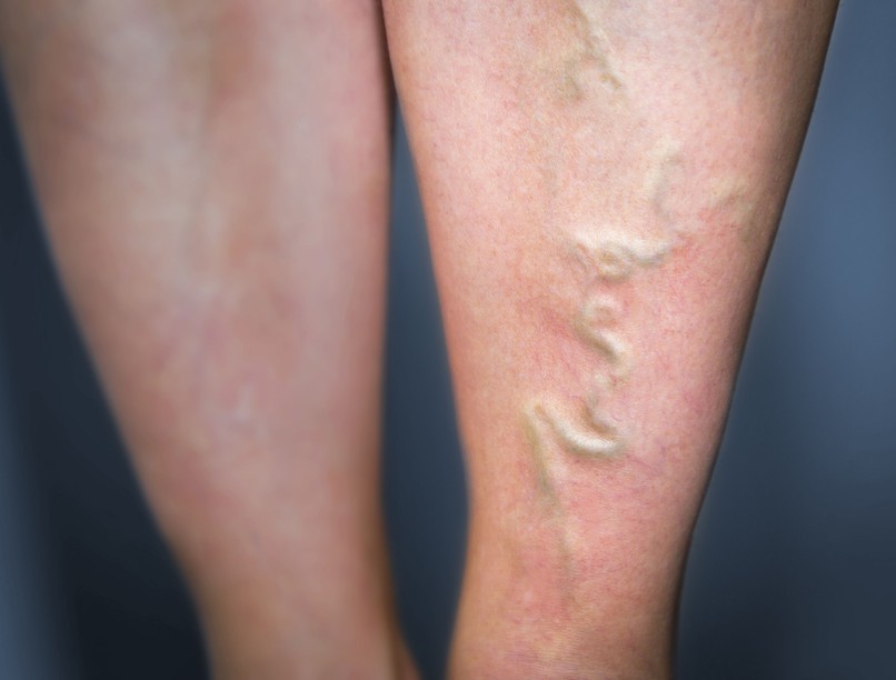 Visszeres láb visszérkrém