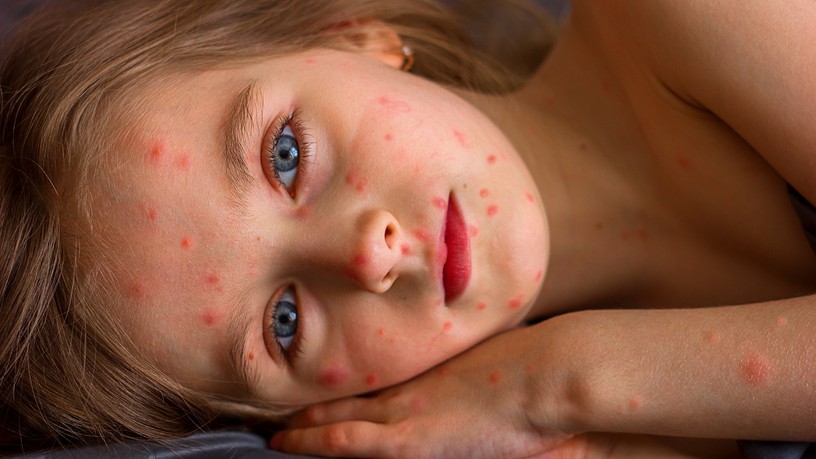 bárányhimlő oka tünet kezelés