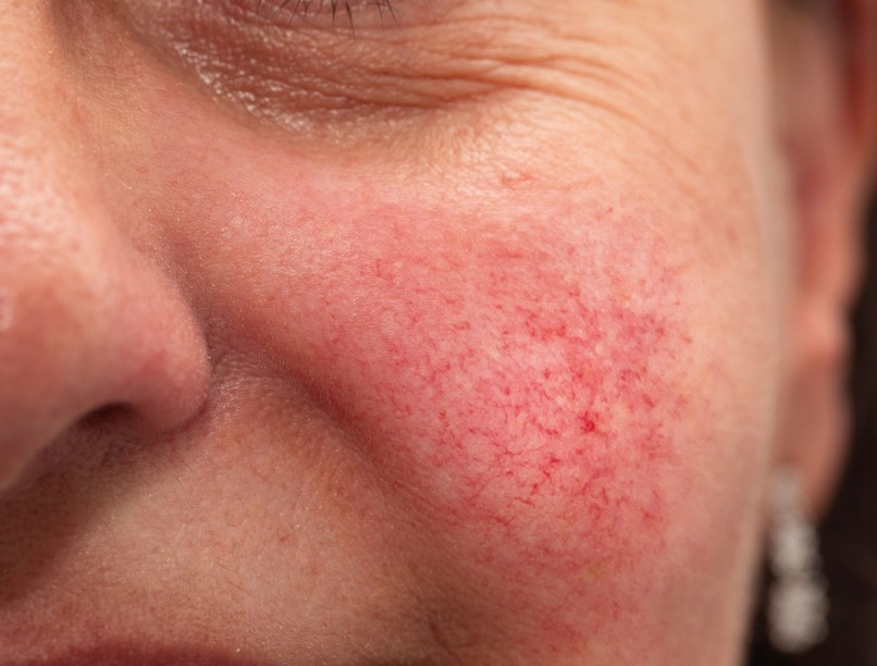 piros arcbőr oka autoimmun betegség lupus tünete