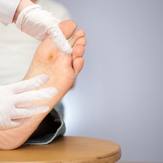 Hiába kezeli otthon, a szemölcs gyakran visszatér – így kezelhető eredményesen című cikk nyitóképe