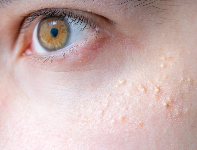 milium, gríz, bőrprobléma