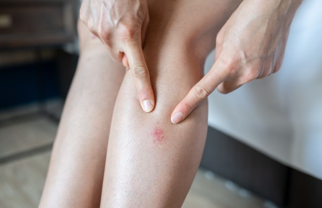 Piros, viszkető, fájó foltok a lábon: mi okozhatja, és tehetünk ellene?