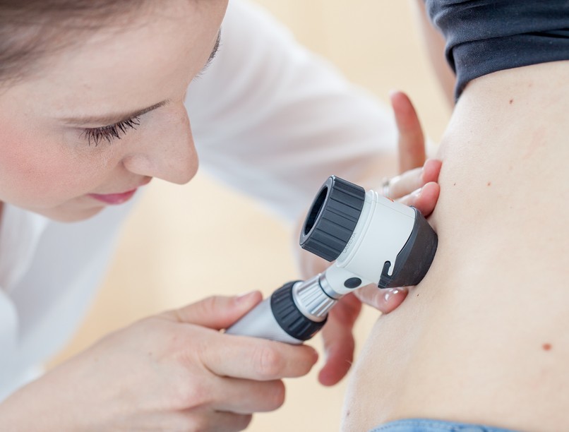 anyajegy szűrés melanóma bőrrák