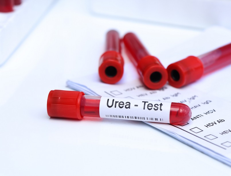 Mit jelent karbamid érték laborlelet