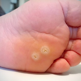 Tyúkszemek és bőrkeményedések című cikk nyitóképe