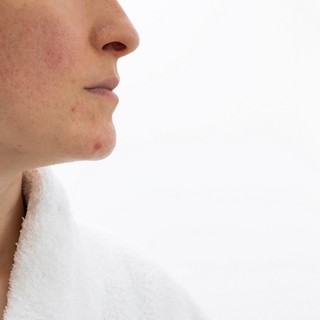 Vörös arc és pókhálóerek az orron? Ez a bőrgyógyász tanácsa, ha rosaceája van című cikk nyitóképe