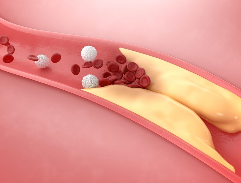 Trombózis tünet vizsgálat kezelés
