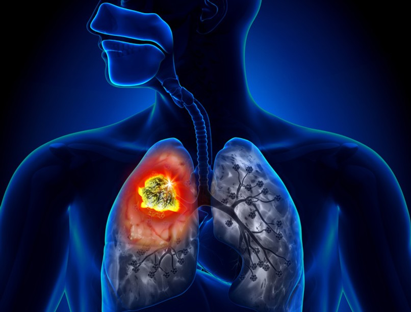 tüdőrák, tünetei, kezelése, daganat, rák