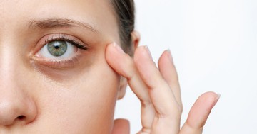  Mitől karikás a szemem, amikor eleget alszom? 