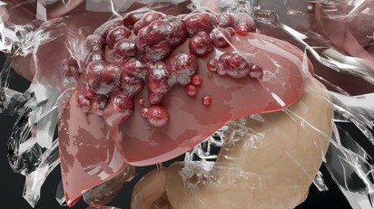 Alkoholos májkárosodás: tünetei, vizsgálata és kezelési lehetőségei című cikk nyitóképe