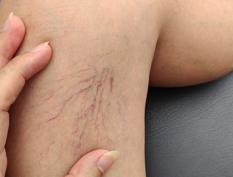 mitől alakul ki a visszér betegség