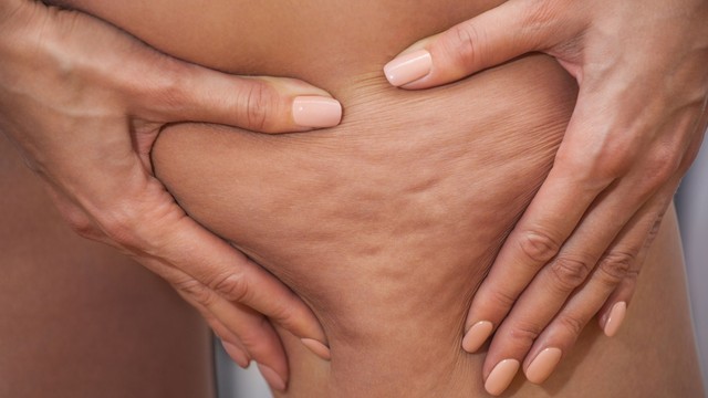 Lipödéma vagy cellulit? Sokan összekeverik, pedig nem ugyanaz