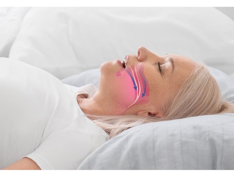 éjszaka stroke alvás közben megelőzés