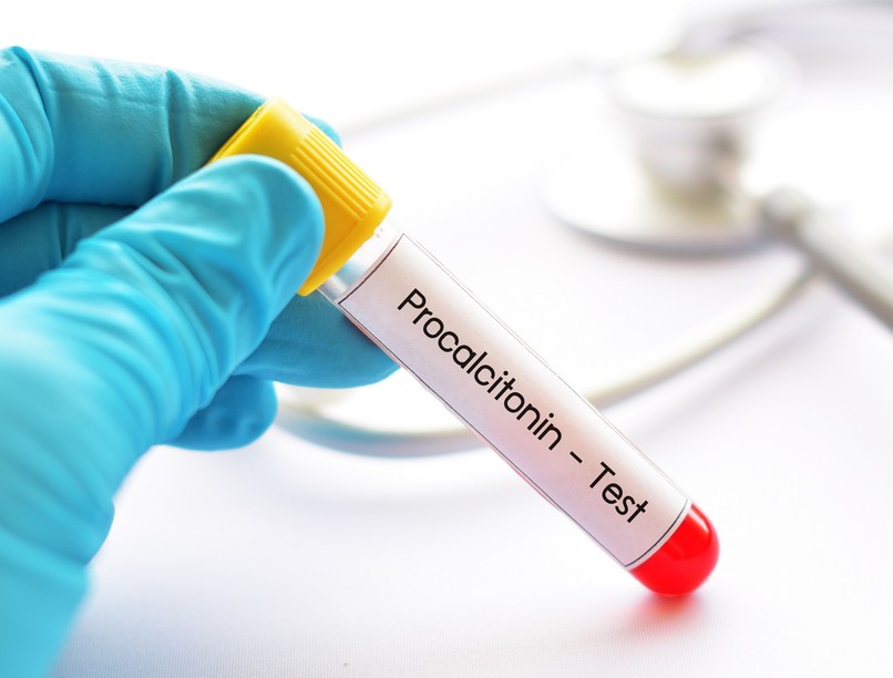 Mit jelent prokalcitonin (PCT) érték laborlelet