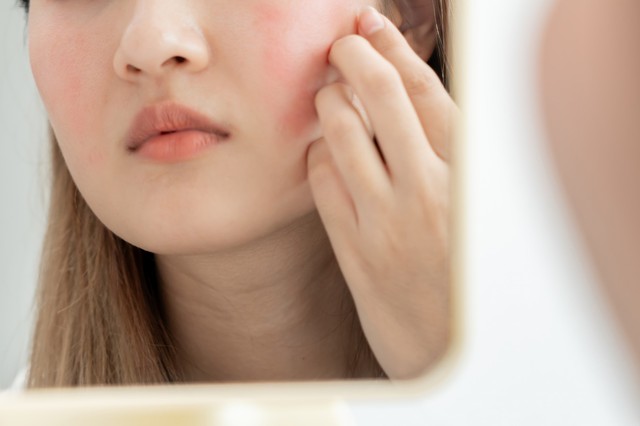 Kipirosodott az orra és az arca a tavaszi naptól? Rosacea is okozhatja