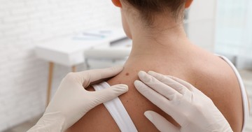  Eltávolítható az anyajegy akkor is, ha nem okoz gondot? 