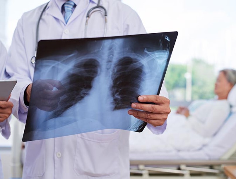 tüdőgyulladás típusai, tüdőgyulladás tünete, tüdőgyulladás kezelése, tüdőgyulladás szövődménye, koronavírusos tüdőgyulladás, bakteriális tüdőgyulladás, tüdőgyulladás BNO