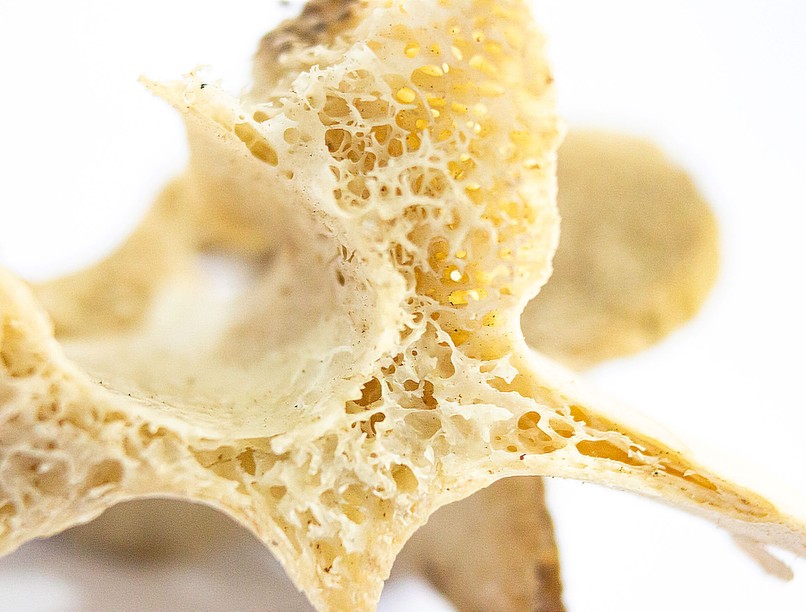 osteoporosis csontritkulás kezelés nélkül
