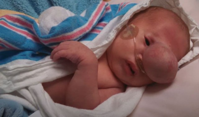 Óriási daganatot műtöttek le a kisbaba arcáról, az anyukája elsírta magát az operáció után