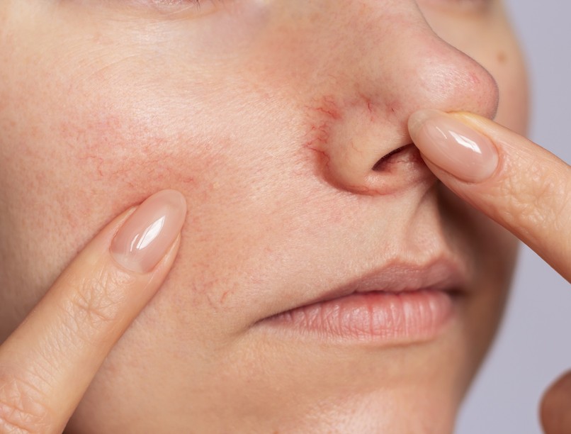 rosacea oka orr erek