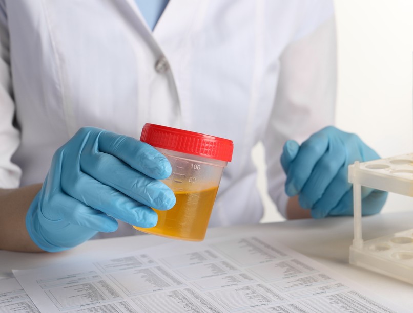 cukorbetegség vizelet mikroalbumin vizsgálat szűrés