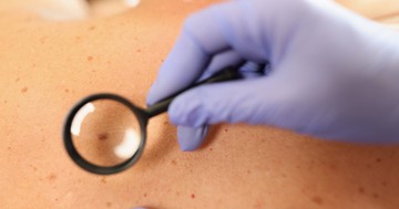  Anyajegy eltávolítása: bőrgyógyászhoz vagy sebészhez menjünk? 