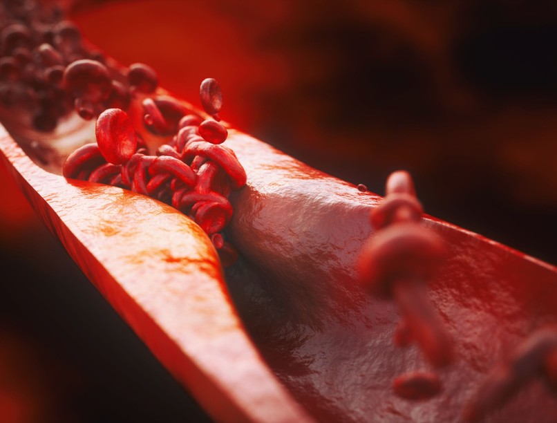 magas koleszterin ellen koleszterinszint csökkentés gyógyszer nélkül