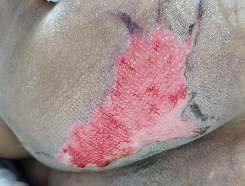 Felfekvés decubitus