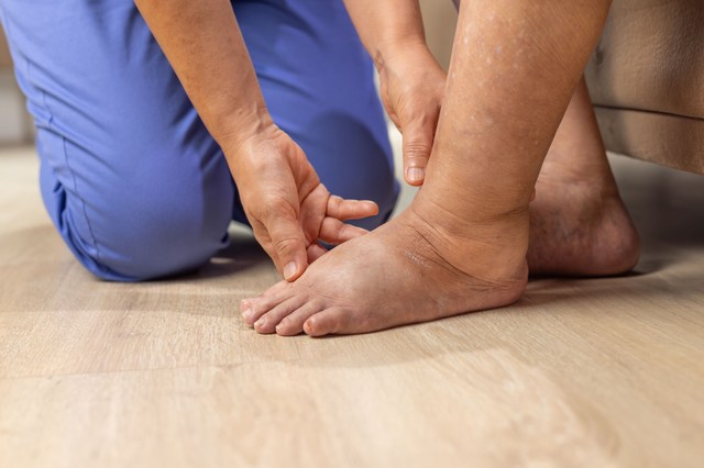 Egyre gyakrabban dagad be estére a lába? Nem biztos, hogy ártalmatlan jelenségről van szó