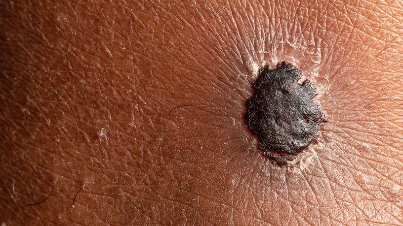 melanoma első jelei