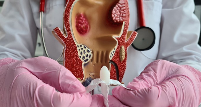 Lehet-e bajom az ilyen, házilag kikevert kúptól? Az orvos válaszol című cikk nyitóképe