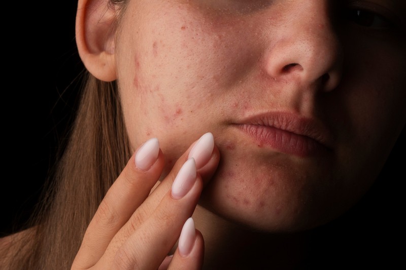 Felnőttkori pattanások: miért nem csak kamaszprobléma?