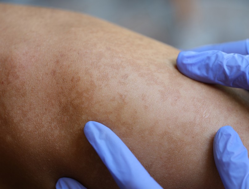 hiperpigmentáció pigmentfolt oka tünet kezelés