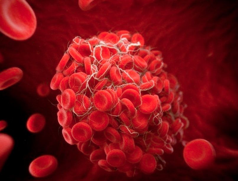 venous-thromboembolism_0