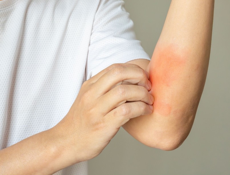 mikor orvoshoz menni viszketés esetén