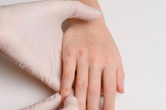 Nem csak esztétikai gond: így kezelhetők biztonságosan a gyermekkori szemölcsök