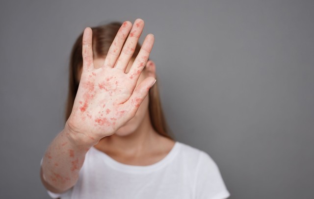 Hiába a vakcina, mégis terjed: miért nem tűnik el a kanyaró Európából?