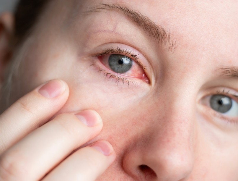 kötőhártya gyulladás kezelése házilag