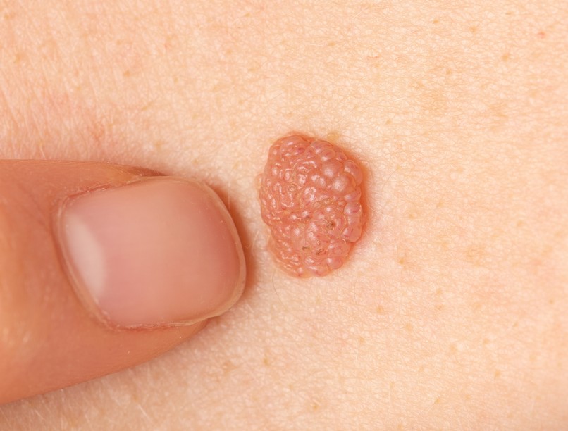 anyajegy, növedék kölönbség bőrrák tünet